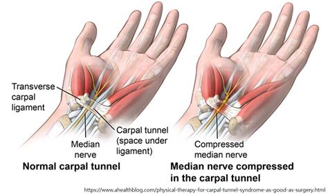 Carpal Tunnel Syndrome Rehab For A Better Life