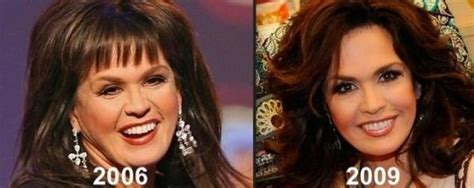 Marie Osmond Plastic Surgery For Facelift Marie Osmond Plastic