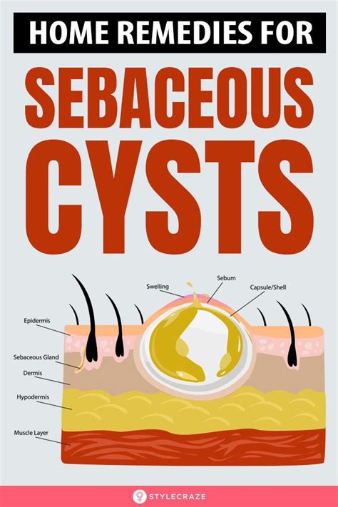 14 Home Remedies To Treat Sebaceous Cysts Home Remedies For Cysts