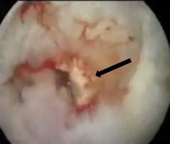 Arthroscopic Removal Of Intraosseous And Intratendinous Deposits In