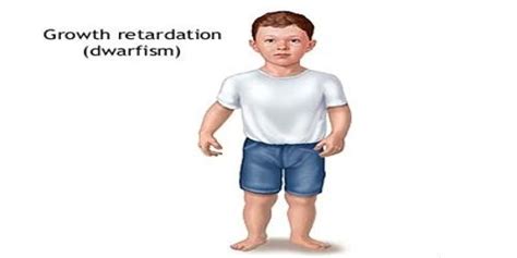 Dwarfism Definition