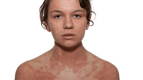 Dermatite atópica adulto Compreendendo uma condição crônica da pele