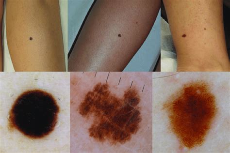 Clinical And Dermoscopic Views Of 3 Melanomas In Situ Located On The