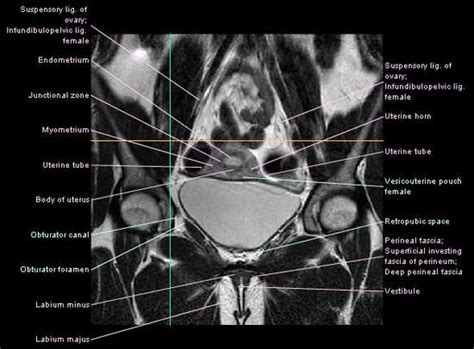Diagnostic Imaging Mri Hip Anatomy