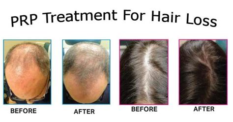 Prp Treatment For Hair Loss Benefits Side Effects And Cost In India