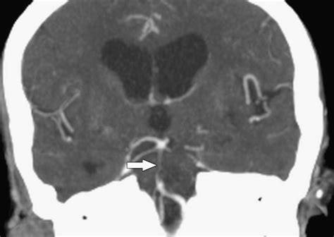 Basilar Artery Occlusion Prognostic Signs Of Severity On Computed