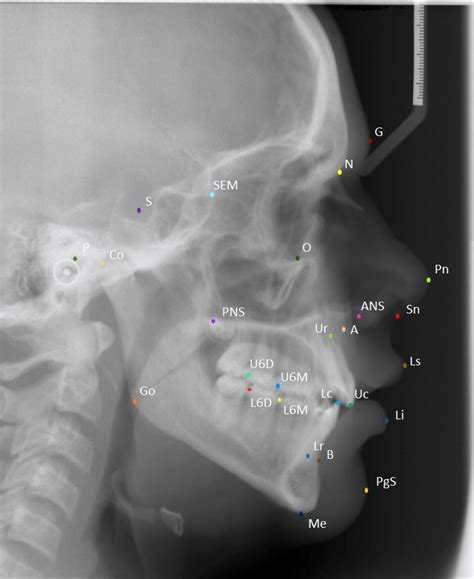 A Sample Cephalometric X Ray Showing The True Positions Of The 26