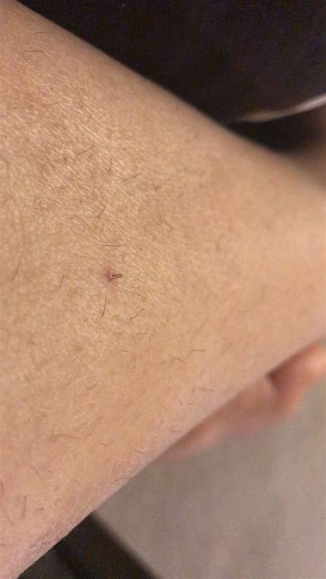 A Small Ingrown Hair Found On My Leg Sorry For Poor Lighting And Yes