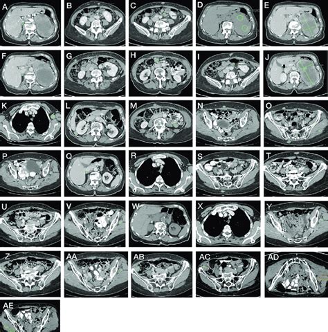 Contrast Enhanced Computed Tomography A E July 2014 Pathological