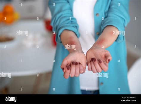 Allergic Woman Having An Urticaria On Her Hands Stock Photo Alamy