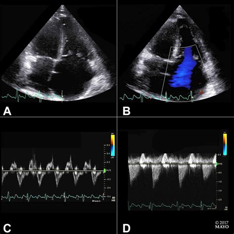 Isolated Tricuspid Regurgitation Outcomes And Therapeutic