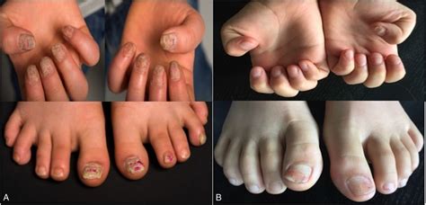 Idiopathic 20 Nail Dystrophy Bmj Case Reports