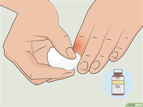 How To Treat A Hot Glue Burn