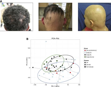 Alopecia Areata Profiling Shows Th1 Th2 And Il 23 Cytokine Activation