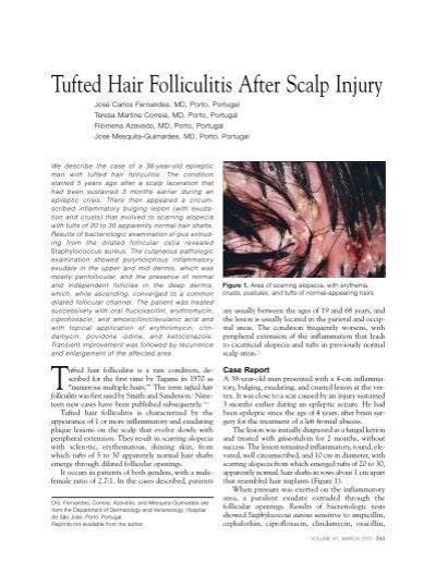 Tufted Hair Folliculitis
