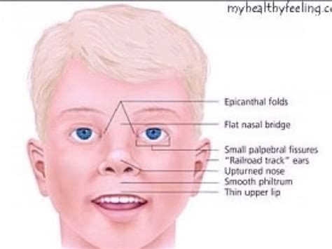 A Description Of Prader Willi Syndrome