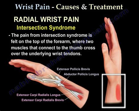Wrist Pain Causes And Treatment Part Everything You Need To Know