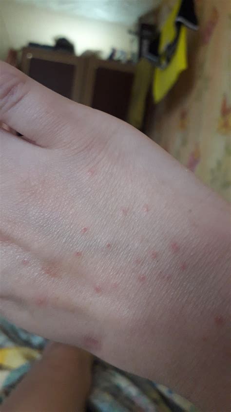 Сыпь на руке без зуда Вопрос дерматологу 03 Онлайн