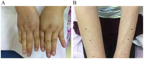 Lymphedema In Survivors Of Breast Cancer Review