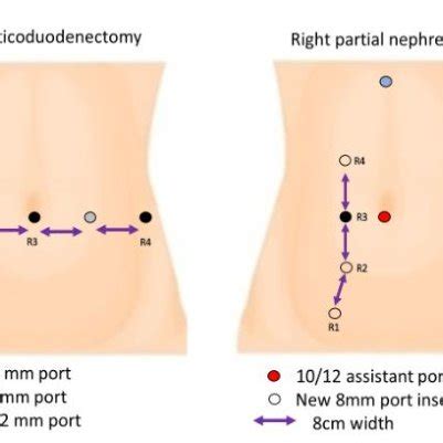 Diagram Of Port Placement During Pancreaticoduodenectomy And Right Download Scientific Diagram