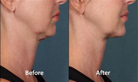 Kybella Center For Cosmetic And Clinical Dermatology