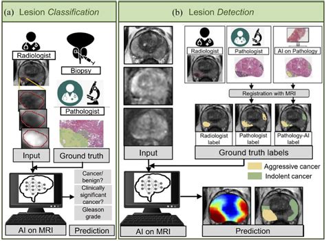 Ai Models For Prostate Cancer Detection On Mri Can Be Subdivided Into