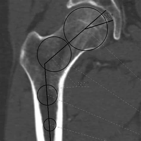 Determining The Femoral Neck Axis In Transverse View A At The Level Of