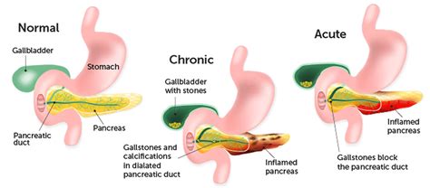 Pediatric Pancreatitis Causes Symptoms Diagnosis Treatment And Prognosis