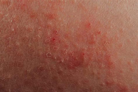 S Ntomas Del Eccema Dermatitis At Pica Medicina B Sica
