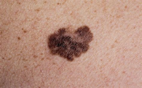 Melanoma And Other Skin Cancers Dermatology Australasia