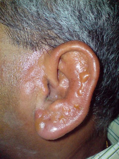 Ear Wax Drops Dangers Dr Paulose