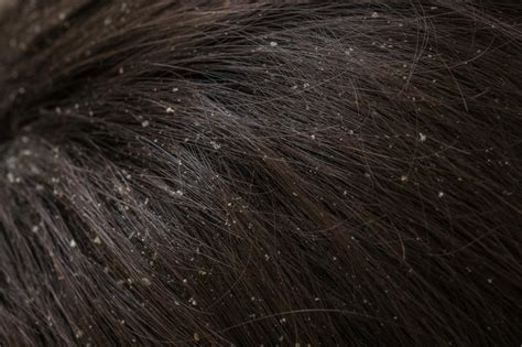Dandruff Vs Dry Scalp Causes Treatment And Prevention