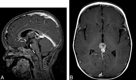 Brain Abnormalities On Mr Imaging In Patients With Retinoblastoma