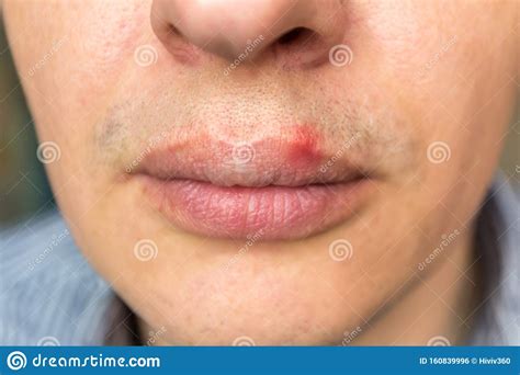 The information provided herein should not be used during any medical emergency or for the diagnosis or treatment of any medical condition. Red Inflammation And Herpes Zoster Virus On Upper Male Lip Stock Photo - Image of condition ...