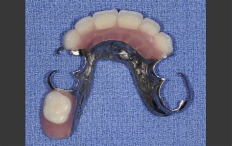 With denture before and after pictures, you see that no situation is hopeless. Upper and Lower Removable Partial Dentures without ...