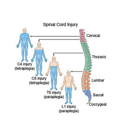 Spinal Cord Injury Attorneys Brown And Crouppen Law Firm