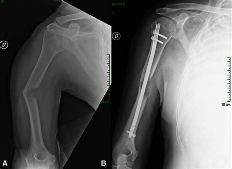 Protocol Of Surgical Treatment Of Long Bone Pathological Fractures Injury