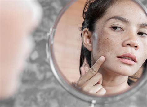 11 Ways To Get Rid Of Dark Spots Effectively Procaffenation