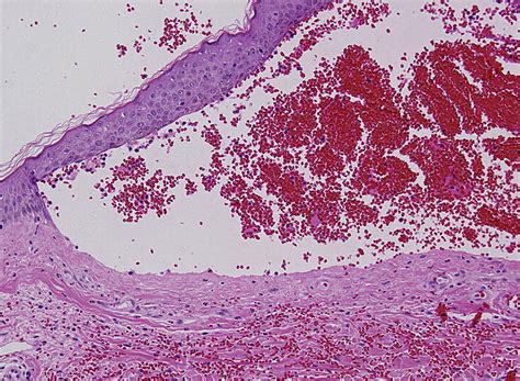 Bullous Hemorrhagic Dermatosis At Sites Distant From Subcutaneous