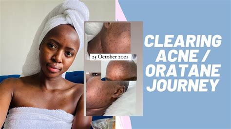 Clearing My Acne Dark Spots Oratane Journey Side Effects South African Youtuber Vlogmas
