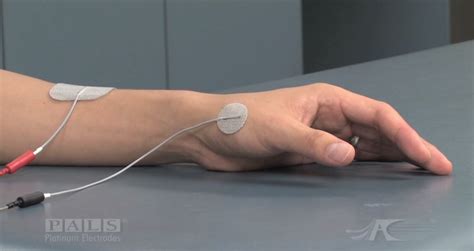 Best Electrode Placement For Arm And Hand Stroke Rehabilitation