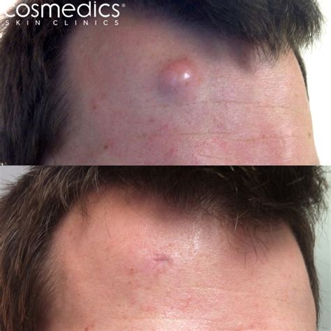 Cyst Removal London Surgical Treatment Cosmedics Skin Clinics
