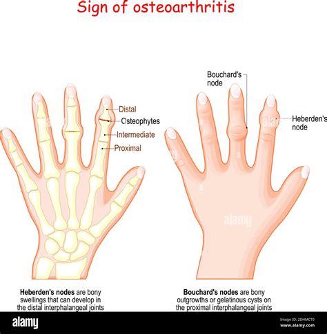 Signo De Osteoartritis Mano Humana Con El Nodo De Heberden Y El Nodo De Bouchard Ilustración