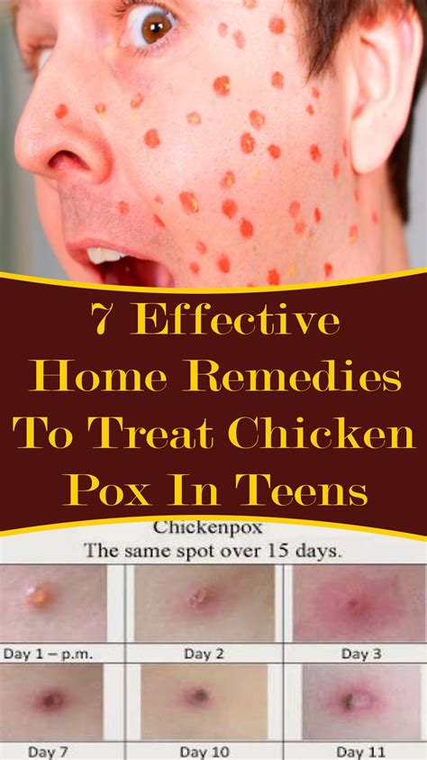 7 Effective Home Remedies To Treat Chicken Pox In Teens Aorelheart