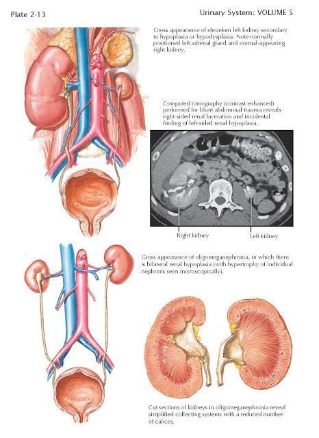 Renal Hypoplasia A Normal Kidney Contains Approximately 600000 To