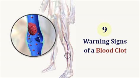 10 Signs Of Blood Clot