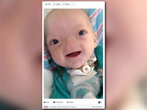 Miracle Baby Born Without Nose Dies At 2