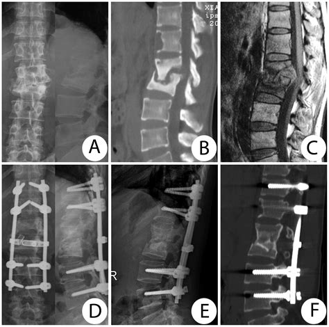 Two One‑stage Posterior Approaches For Treating Thoracic And Lumbar