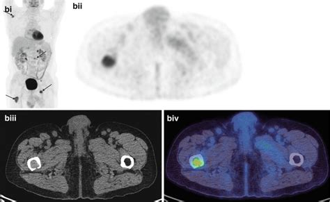 Clinical Applications Of Petct In Oncology Radiology Key