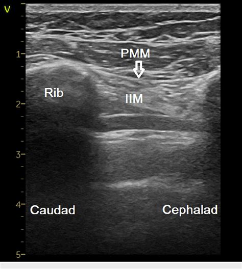 Figure 2 From Awake Sternal Fixation Using The Ultrasound Guided